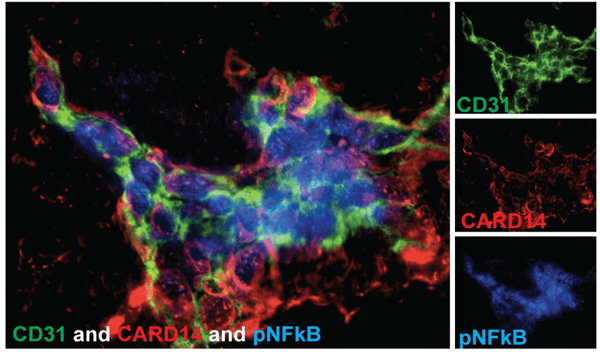 Immunofluorescence staining of CD31 (green), CARD14 (red), and pNFkB (blue) overlapped on the left part of the image. Each individual channel is show on the right panel.
