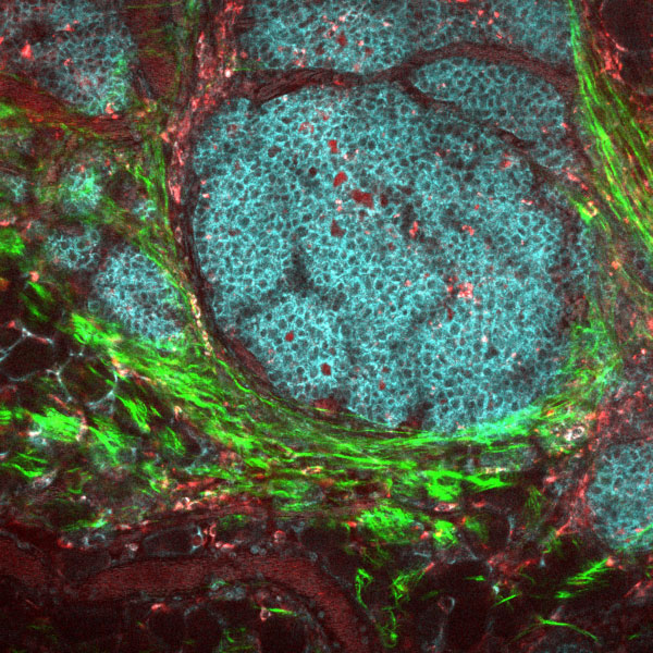 addgene-blog-breast-cancer-microenvironment-fluorescence-microscopy